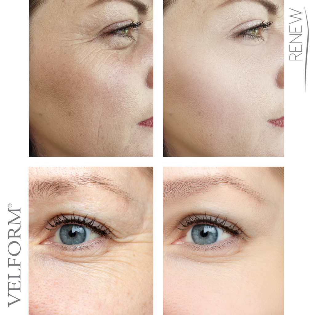 Adesivos Solúveis Colágeno e Ácido Hialurónico para o Rosto