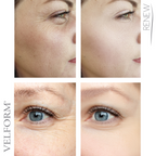 Adesivos Solúveis Colágeno e Ácido Hialurónico para o Rosto